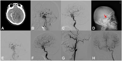 Case report: emergent endovascular treatment for carotid cavernous fistulas presenting as intracranial hemorrhage